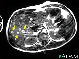 Melanoma of the liver - MRI scan