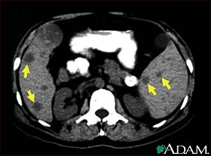 Spleen metastasis - CT scan