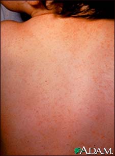 ECHO virus type 9 exanthem