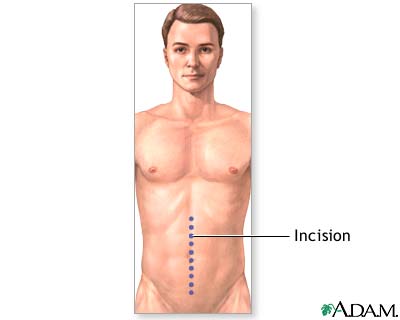 Incision