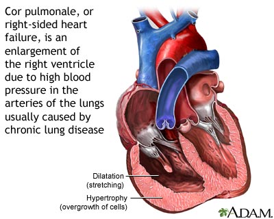 Cor pulmonale