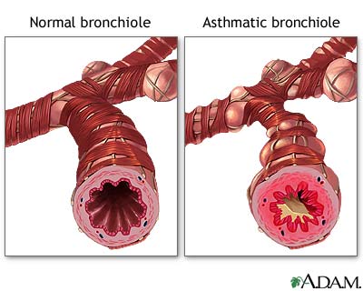 Normal versus asthmatic bronchiole