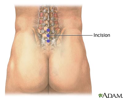 Incision