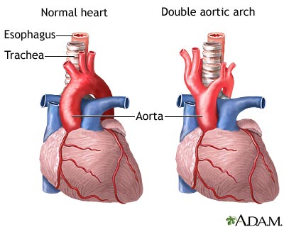 Double aortic arch