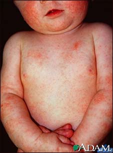 Dermatitis, atopic in an infant