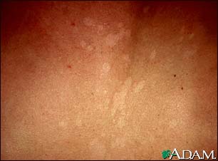Tinea versicolor - close-up