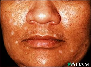 Vitiligo, drug induced