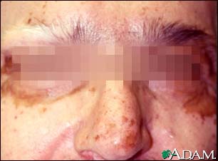 Vitiligo on the face