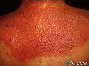 Lichen simplex chronicus on the back