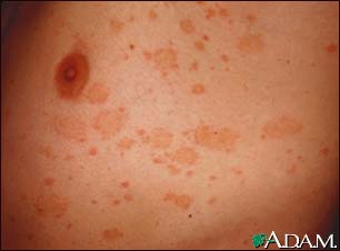 Pityriasis rosea on the chest