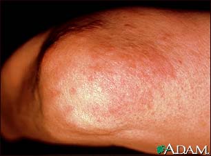 Granuloma, annulare on the elbow