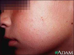 Keratosis pilaris on the cheek