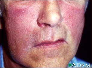 Erysipelas on the face