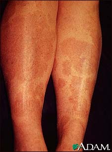 Granuloma, annulare on the legs