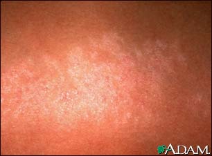 Lichen striatus - close-up