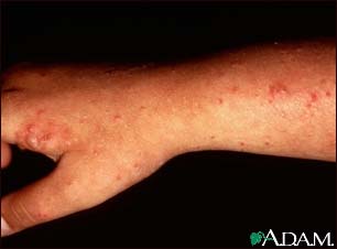Polymorphic light eruption on the arm