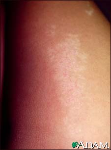 Lichen striatus - close-up