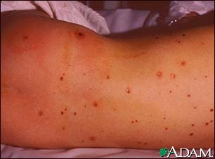 Meningococcal lesions on the back