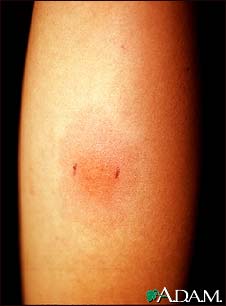 Positive PPD skin test