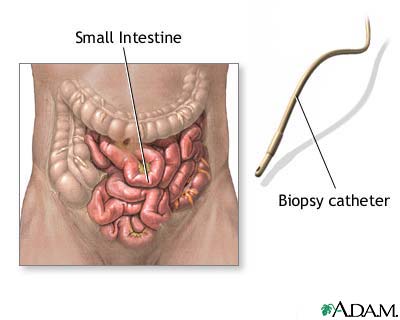 Small intestine biopsy
