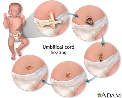 Umbilical care