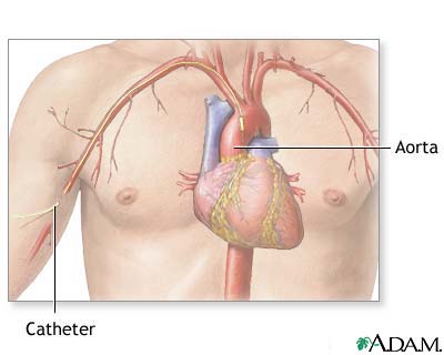 Cardiac arteriogram
